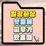 일광화상-팻볕에-피부가-탔을-때